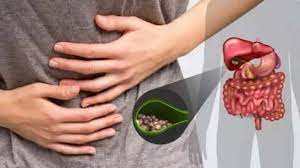 هل يُسبب نظام الكيتو حصوات المرارة؟